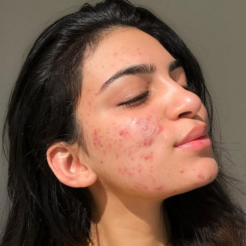 Kinds of Acne: How to Clear and Prevent it without Damaging your Skin